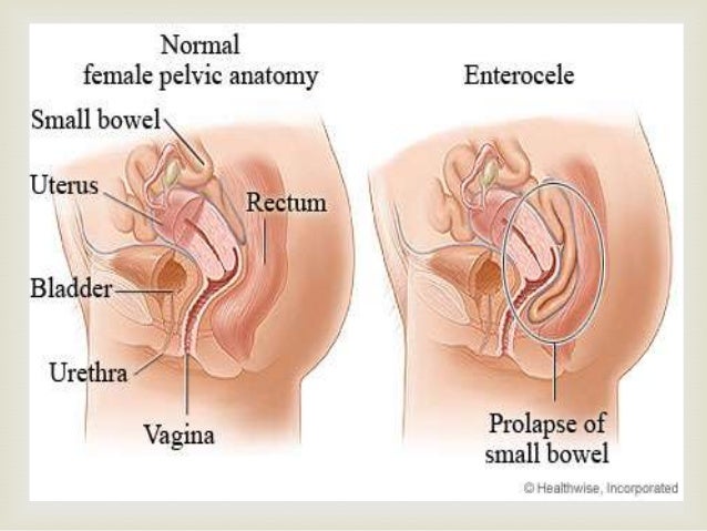 Cervix coming out of vagina How do girls loose their virginity